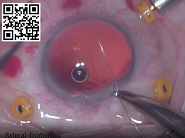 Edited Film Combined Artificial Iris IOL Implantation in Traumatic Aphakia Aniridia Edited Film Combined Artificial Iris IOL Implantation in Traumatic Aphakia Aniridia