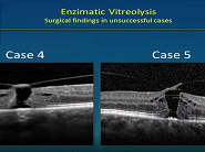 Edited Film Internal Limiting Membrane in Macular Surgery