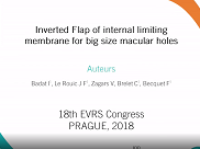 Edited Film Inverted Flap of Internal Limiting Membrane