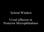Edited Film Open Windows Uveal Effusion Secondary to Posterior Microphthalmos