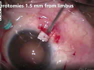 Edited Film Raising The Titanic  Rescue Missions for Dislocated IOLs