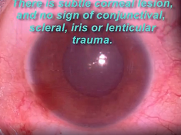 Edited Film Unseen Foreign Body with Biomicroscopy