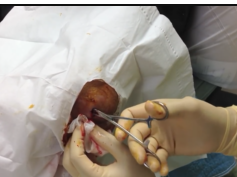 Elbow Abscess - re-make and repost of original video