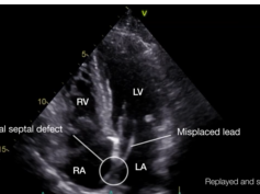 Embolic Stroke From a Misplaced Pacemaker Wire