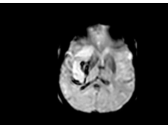 Embolic Stroke With Hemorrhage After Stent and Aspiration Thrombectomy Embolic Stroke With Hemorrhage After Stent and Aspiration Thrombectomy