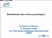 Embolisation des artères prostatiques Embolisation des artères prostatiques