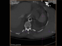 Embolization of a Bleeding Intercostal Artery Embolization of a Bleeding Intercostal Artery
