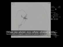 Embolization of Temporal Arteriovenous Malformations Embolization of Temporal Arteriovenous Malformations