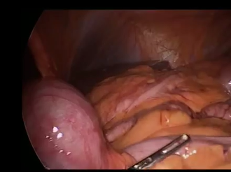 Emergency Laparoscopic Colectomy for Caecal Volvulus