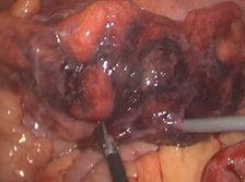 Emergency laparoscopic Hartmanns procedure for Hinchey IV left colonic diverticulitis Emergency laparoscopic Hartmanns procedure for Hinchey IV left colonic diverticulitis