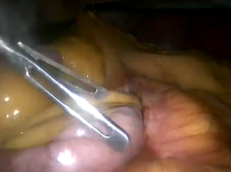 Emergency laparoscopic repair of an incarcerated obturator hernia