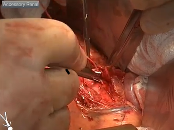 End to Side Proximal Case (Alan B. Lumsden, MD) End to Side Proximal Case (Alan B. Lumsden, MD)