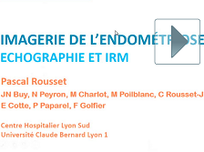 Endometriose pelvienne