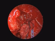 Endoscopic Approach for Intraconal Biopsy