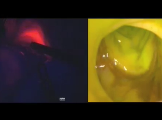Endoscopic Confirmation of Colorectal Anastomosis Perfusion by Near-infrared Fluorescence Endoscopic Confirmation of Colorectal Anastomosis Perfusion by Near-infrared Fluorescence