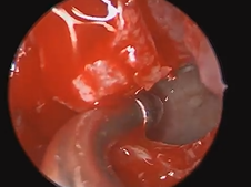 Endoscopic Endonasal Transpterygoid Approach (EETA) for Recurrent Meningioma