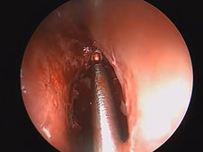 Endoscopic Frontal Sinusotomy, Draf IIa Procedure