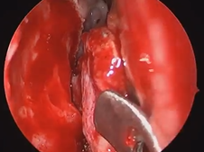 Endoscopic Inferior Turbinate Flap for Clival Defect Reconstruction