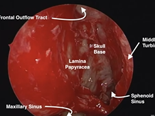 Endoscopic Orbital Decompression