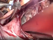 Endoscopic port-access approach for excision of left atrial myxoma