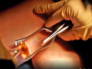 Endoscopic saphenous vein harvesting with a non-sealed approach