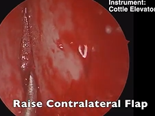 Endoscopic Septoplasty