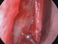 Endoscopic Septoplasty
