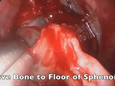 Endoscopic Transsphenoidal Approach for Pituitary Tumor Resection