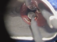 Endoscopic Type I Laryngeal Cleft Repair