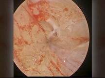 Endoscopic Vein Harvesting for Coronary Artery Bypass Grafting Endoscopic Vein Harvesting for Coronary Artery Bypass Grafting