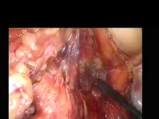 Endoscopically assisted extralevator abdominoperineal excision