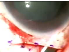 Endothelial Cell Loss and Surgically Induced Astigmatism After Sutureless Large Incision Manual Cata Endothelial Cell Loss and Surgically Induced Astigmatism After Sutureless Large Incision Manual Cata