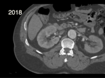 Endovascular Aortic Septotomy Endovascular Aortic Septotomy