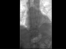 Endovascular Repair (EVAR) of Abdominal Aortic Aneurysm Endovascular Repair (EVAR) of Abdominal Aortic Aneurysm