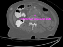 Endovascular Repair of Complex Contained Abdominal Aortic Rupture Endovascular Repair of Complex Contained Abdominal Aortic Rupture
