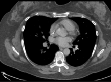 Endovascular Retrieval of Guidewire Fragment from Pulmonary Artery Endovascular Retrieval of Guidewire Fragment from Pulmonary Artery
