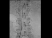 Endovascular Treatment of a Renal Artery Aneurysm Endovascular Treatment of a Renal Artery Aneurysm