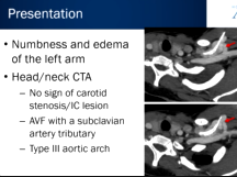 Endovascular Treatment of Iatrogenic Subclavian Arteriovenous Fistula Endovascular Treatment of Iatrogenic Subclavian Arteriovenous Fistula