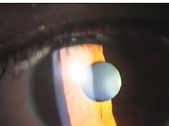 Entire Attack With Pupillary Reaction and Fundus Image Entire Attack With Pupillary Reaction and Fundus Image