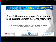 Enucléation endoscopique d'une tumeur sous-muqueuse gastrique avec fermeture