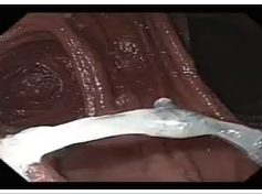 Eroded Suture after Gastric Bypass