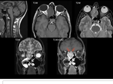 ERS Webinar Autumn Series: Managing esthesioneuroblastoma - an expert's guide
