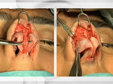 ERS Webinar Autumn Series: Trends in Functional Rhinoplasty