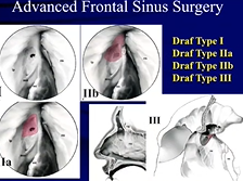 ERS Webinar Series (June 16): Frontal Sinus