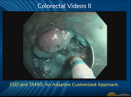 ESD and TAMIS: An Adaptive Customized Approach