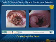 Esophagogastric Leak