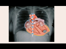 Etat cardiaque et prise de décision - Implantation d'appareils d'assistance ventriculaire contemporaire Etat cardiaque et prise de décision - Implantation d'appareils d'assistance ventriculaire contemporaire