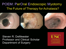 Etat thoracique et prise de décision - Myotomie endoscopique orale (POEM) Etat thoracique et prise de décision - Myotomie endoscopique orale (POEM)