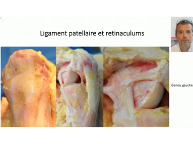 Evolution des facteurs de risque de linstabilité femoro-patellaire Evolution des facteurs de risque de linstabilité femoro-patellaire