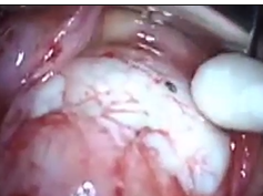 Ex-PRESS Shunt for Uveal Effusion Syndrome Ex-PRESS Shunt for Uveal Effusion Syndrome